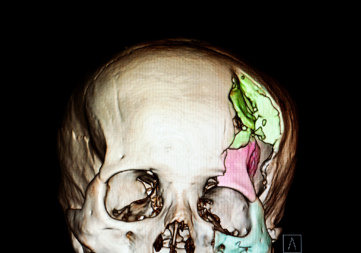 Skull Fracture